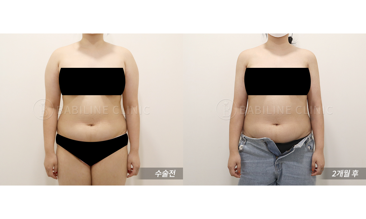 바비라인의원 팔지방흡입[팔+견갑골+브라.. 전후사진