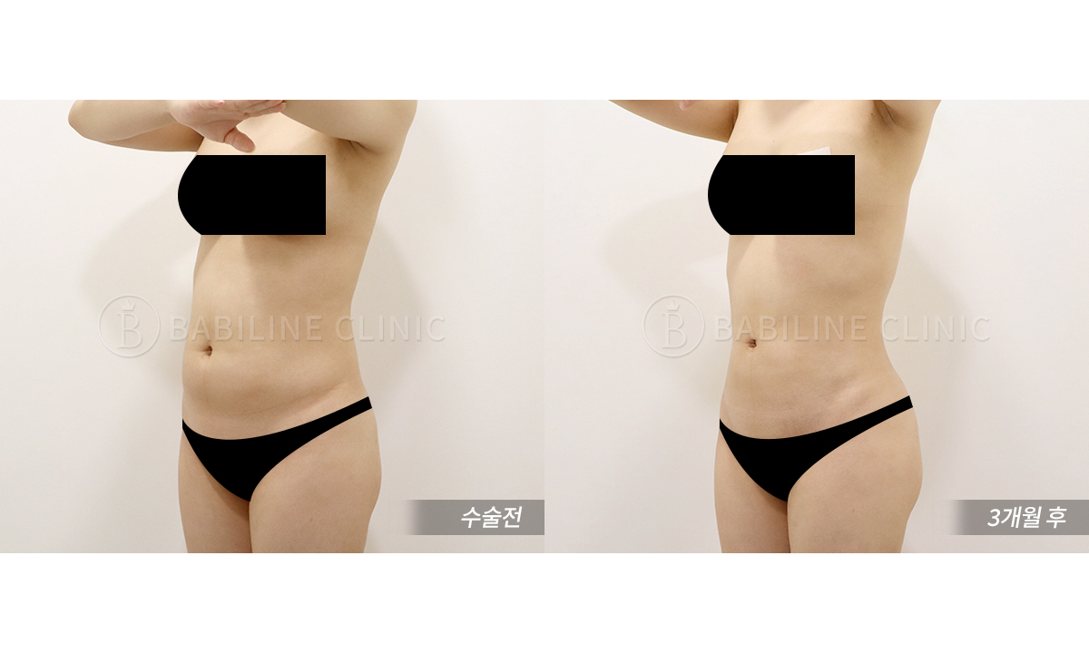 바비라인의원 복부지방흡입[복부+러브핸.. 전후사진