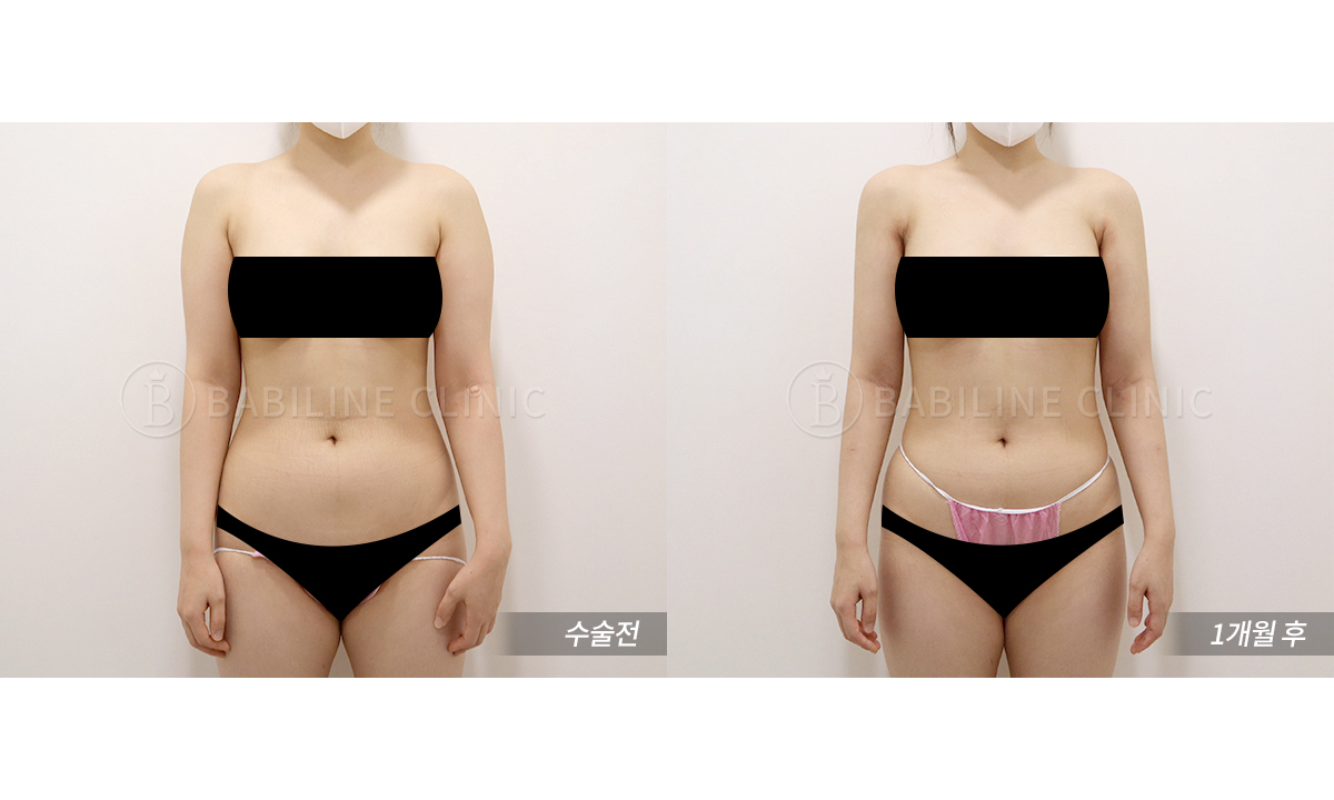 바비라인의원 팔지방흡입[팔+견갑골+브라.. 전후사진