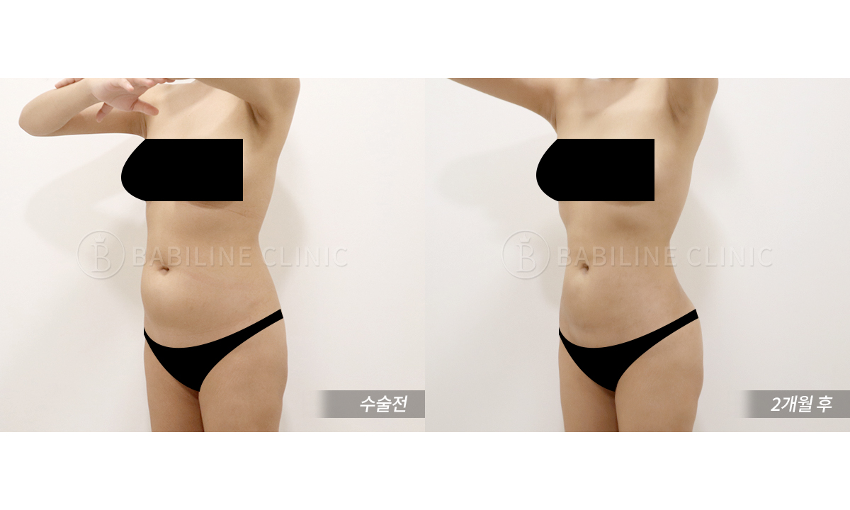 바비라인의원 복부지방흡입[복부+러브핸.. 전후사진