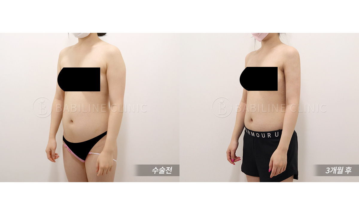 바비라인의원 팔지방흡입[팔+견갑골+브라.. 전후사진