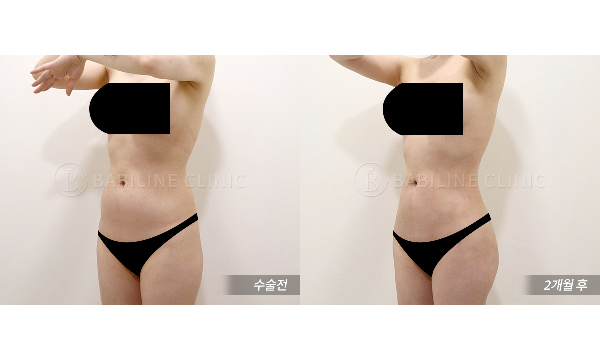 바비라인의원 복부지방흡입[복부+러브핸.. 전후사진