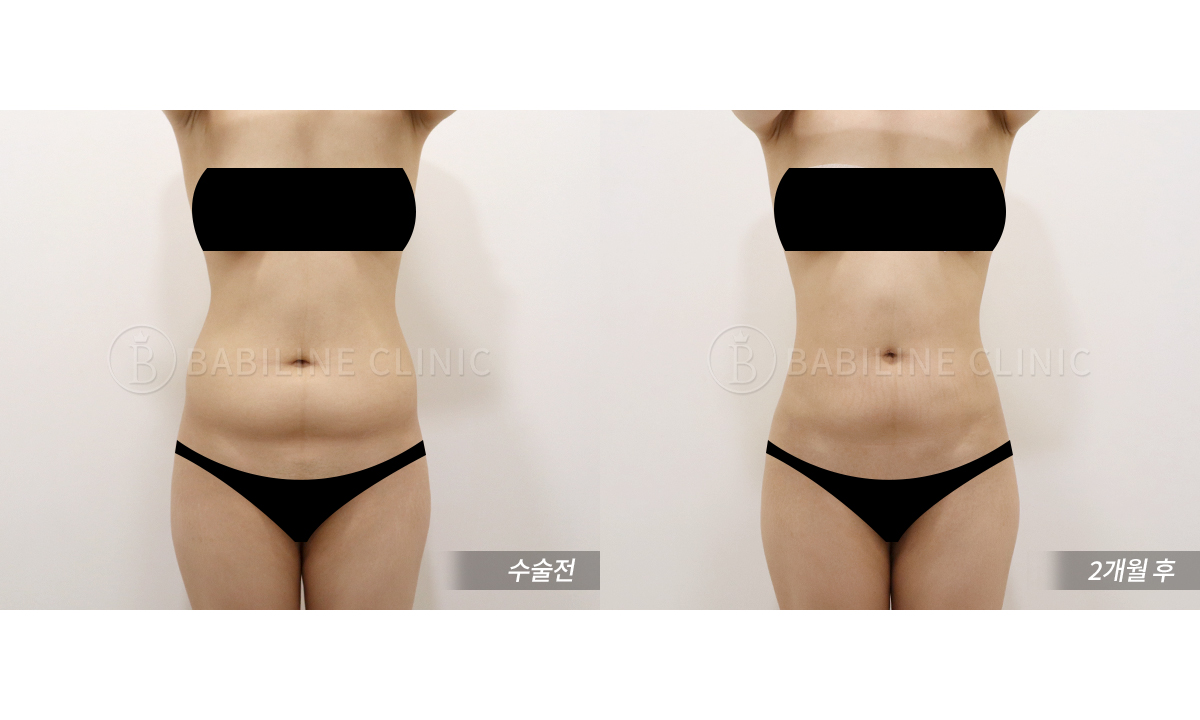 바비라인의원 복부지방흡입[복부+러브핸.. 전후사진
