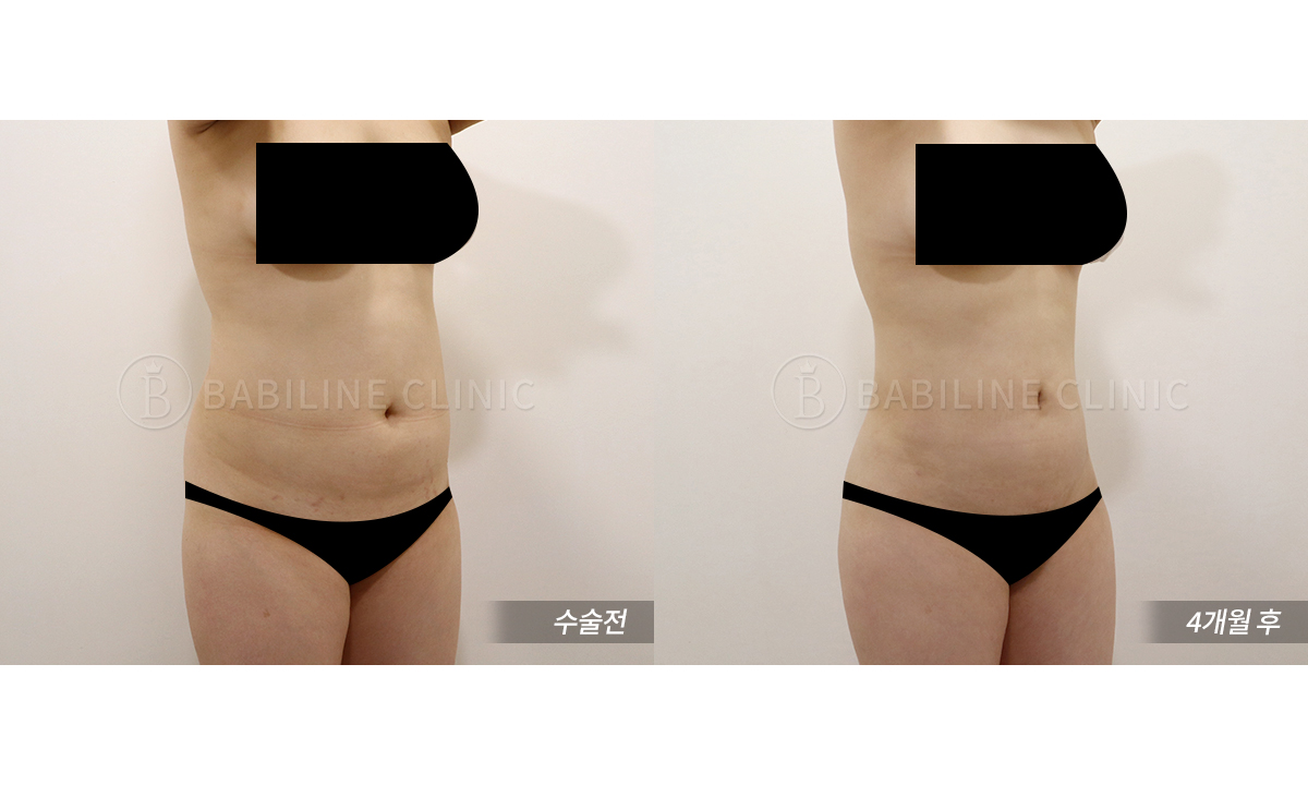 바비라인의원 복부지방흡입(복부+러브핸.. 전후사진