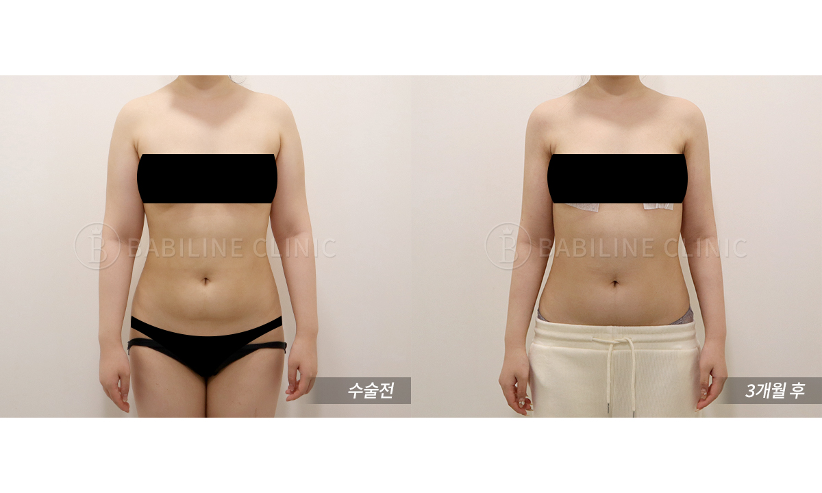 바비라인의원 팔지방흡입[팔+견갑골+브라.. 전후사진