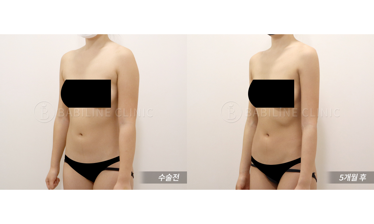 바비라인의원 팔지방흡입[팔+견갑골+쇄골.. 전후사진