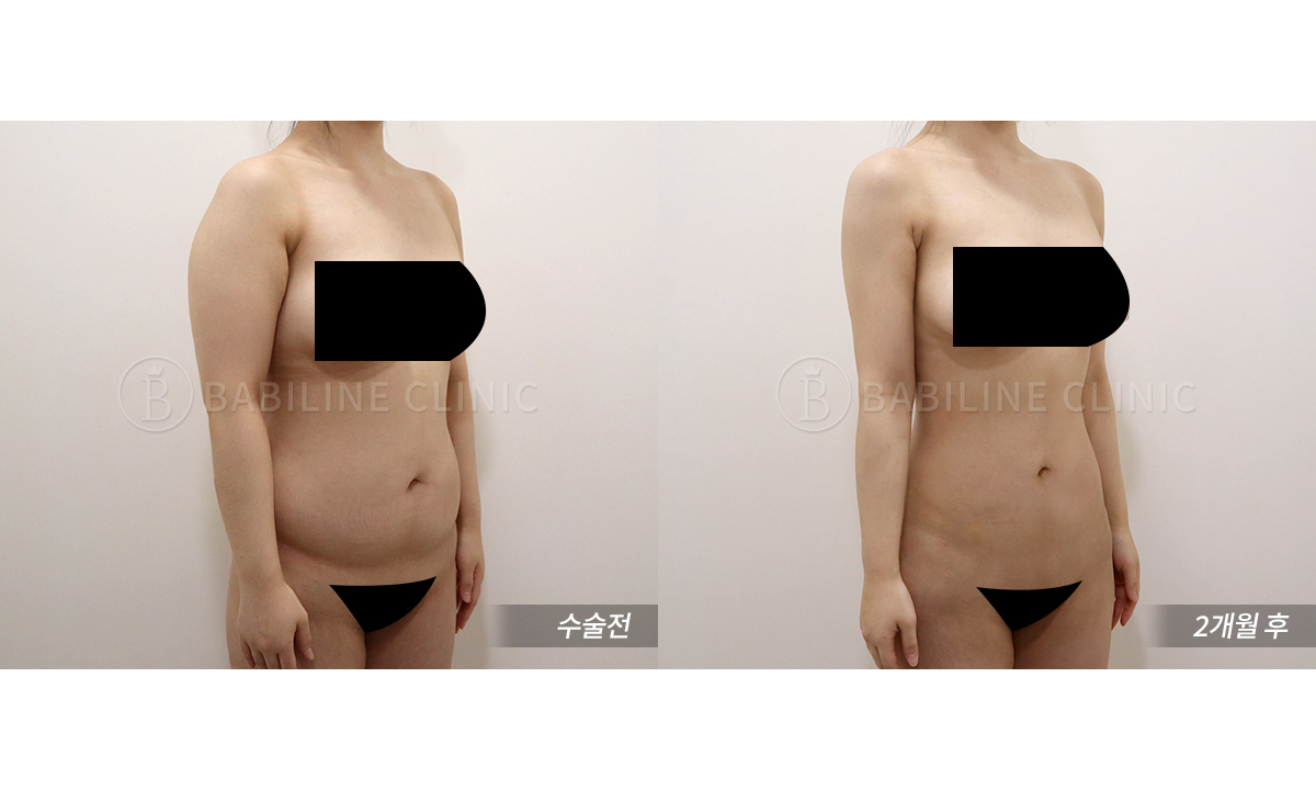 바비라인의원 팔뚝지방흡입[팔뚝+견갑골+.. 전후사진