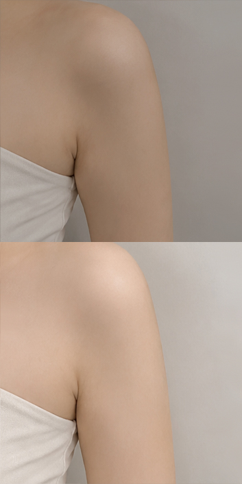 바비라인의원 전후사진