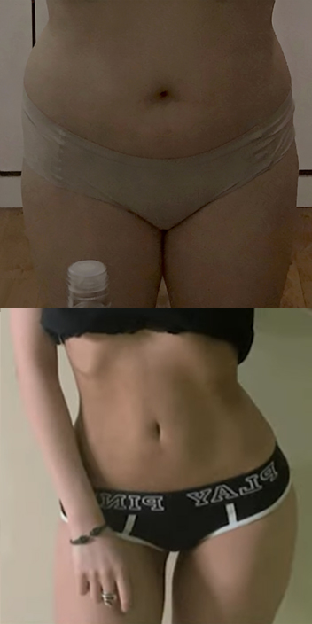 바비라인의원 전후사진