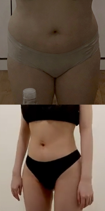 바비라인의원 전후사진