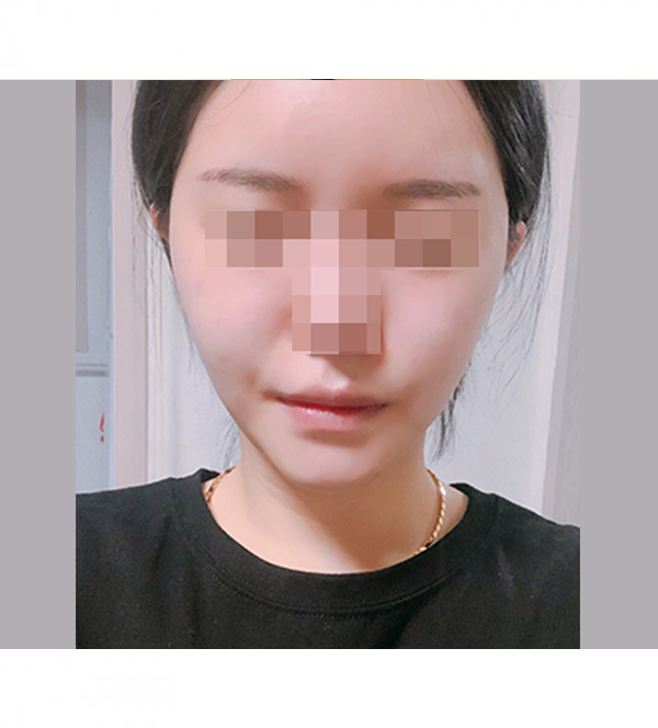 얼굴 지방흡입 수술 후