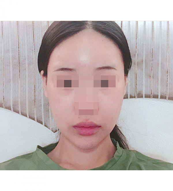 얼굴 지방흡입 수술 후