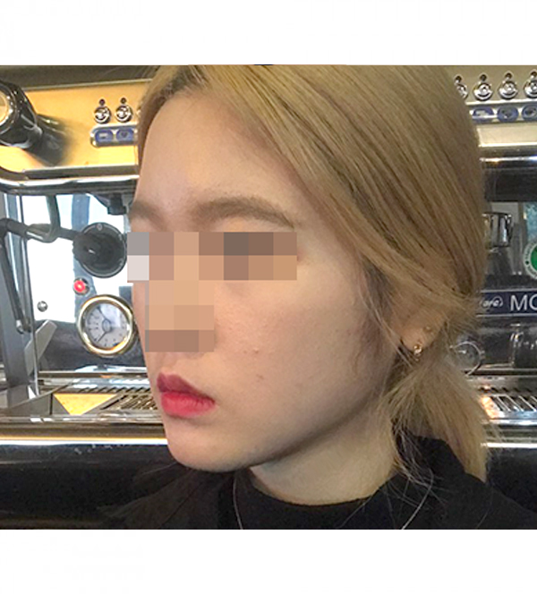 얼굴 지방흡입 수술 후