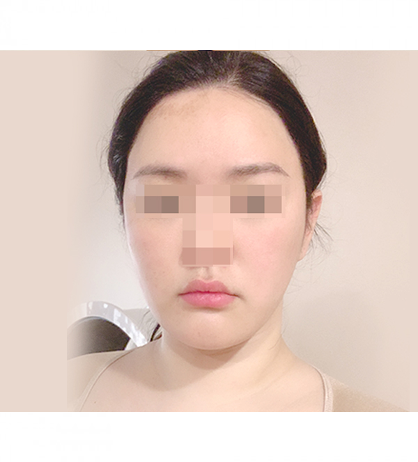 얼굴 지방흡입 수술 후