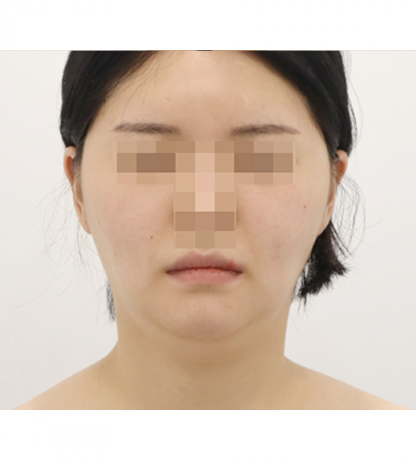 얼굴 지방흡입 수술 전