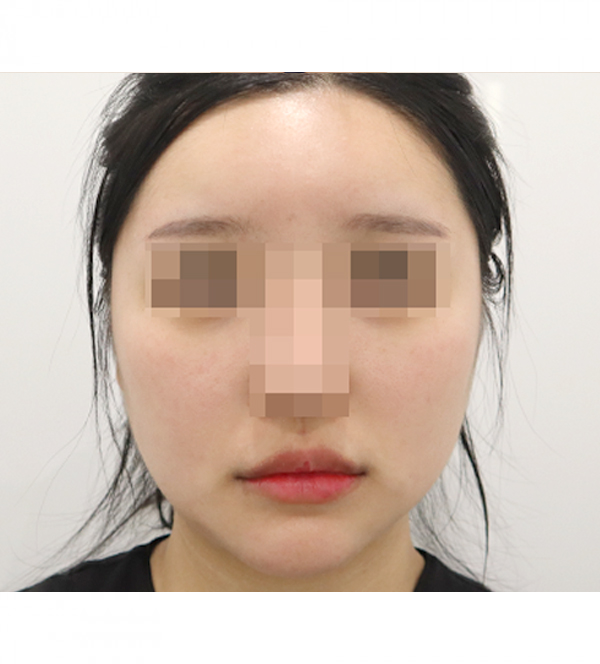 얼굴 지방흡입 수술 전
