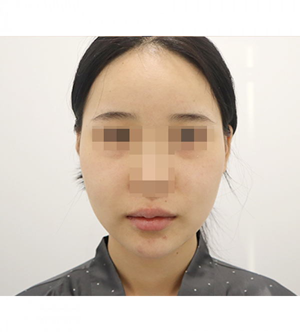 얼굴 지방흡입 수술 전