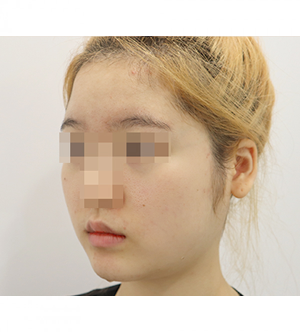 얼굴 지방흡입 수술 전