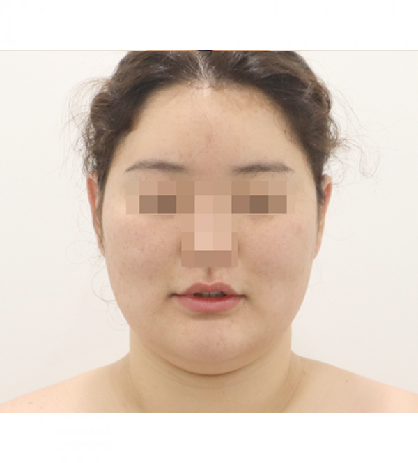 얼굴 지방흡입 수술 전